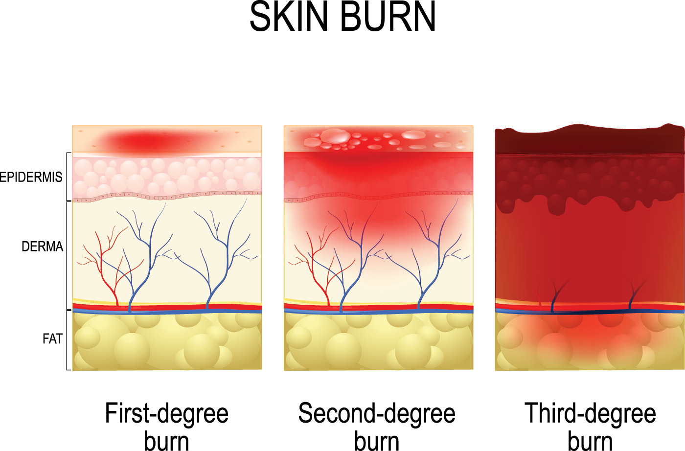 Burn Injury Complications: Infection - USMedicalMalpracticeLawyers.com